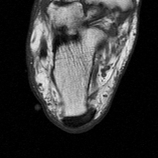 File:Chronic Achilles tendon rupture (Radiopaedia 15262-15100 Axial T1 22).jpg