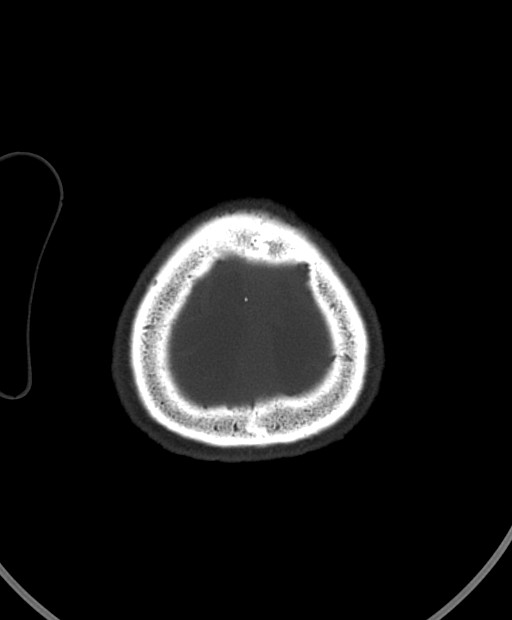 Chronic bilateral subdural hygroma (Radiopaedia 85801-101623 Axial bone window 18).jpg