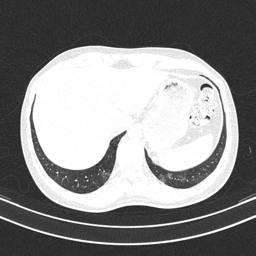 Chronic eosinophilic pneumonia (Radiopaedia 39331-41587 Axial lung window 50).png