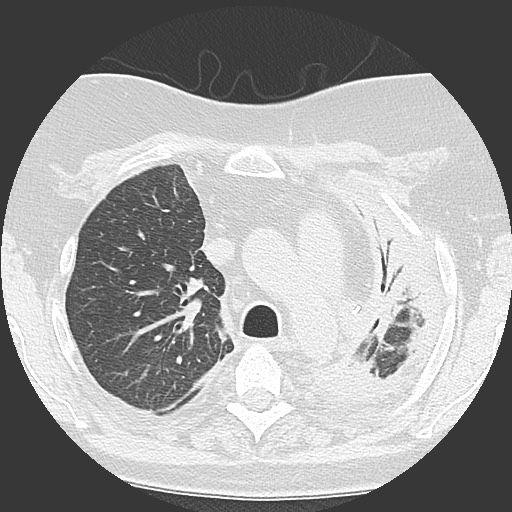 Chronic lung allograft dysfunction - restrictive form (Radiopaedia 60595-68316 Axial lung window 22).jpg