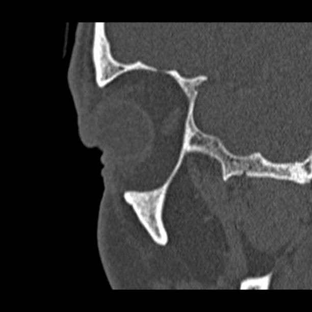 Chronic maxillary sinusitis (Radiopaedia 27879-28116 Sagittal bone window 1).jpg