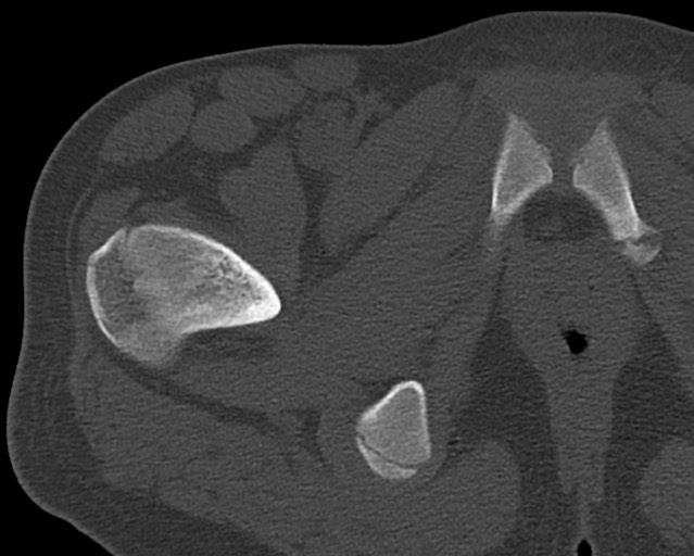 Chronic ostemyelitis of the femur with long sinus tract (Radiopaedia 74947-85982 Axial bone window 12).jpg