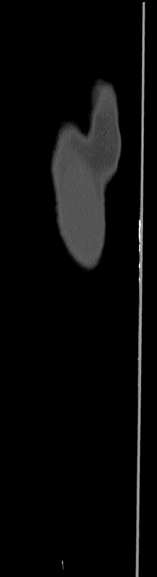 Chronic osteomyelitis (with sequestrum) (Radiopaedia 74813-85822 C 6).jpg