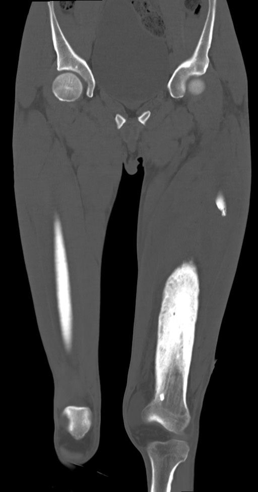 Chronic osteomyelitis (with sequestrum) (Radiopaedia 74813-85822 Coronal non-contrast 20).jpg