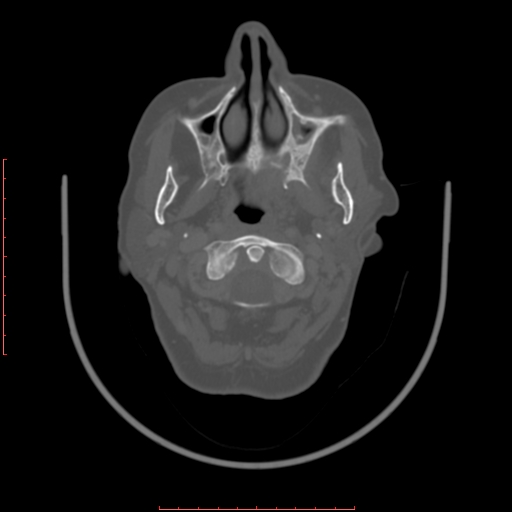 Chronic osteomyelitis - maxilla (Radiopaedia 23783-23927 Axial bone window 92).jpg