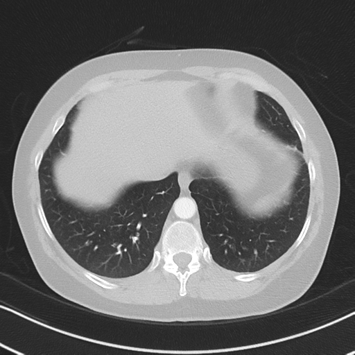 File:Chronic pulmonary embolus (Radiopaedia 39129-41341 Axial lung window 50).png