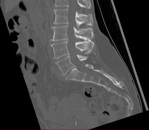 File:Chronic spinal hematoma with cauda equina syndrome (Radiopaedia 75745-88197 Sagittal bone window 15).png