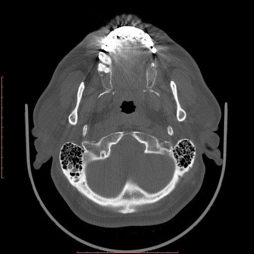 File:Chronic submandibular sialolithiasis (Radiopaedia 69817-79814 Axial bone window 8).jpg