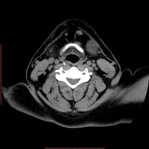 File:Chronic submandibular sialolithiasis (Radiopaedia 69817-79814 Axial non-contrast 150).jpg