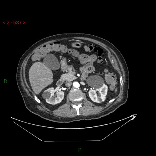 Circumaortic left renal vein and doubled left renal arteries (Radiopaedia 52268-58158 A 73).jpg