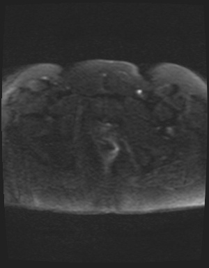 File:Class II Mullerian duct anomaly- unicornuate uterus with rudimentary horn and non-communicating cavity (Radiopaedia 39441-41755 Axial DWI 58).jpg