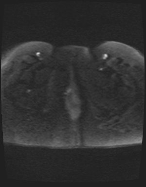 File:Class II Mullerian duct anomaly- unicornuate uterus with rudimentary horn and non-communicating cavity (Radiopaedia 39441-41755 Axial DWI 61).jpg