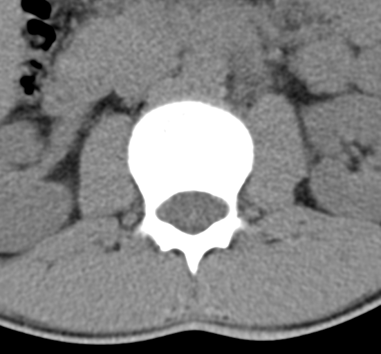 Clear cell meningoma - lumbar spine (Radiopaedia 60116-67691 Axial non-contrast 17).png