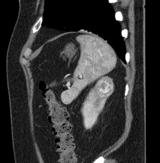 File:Clear cell renal cell carcinoma (Radiopaedia 61449-69393 D 8).jpg