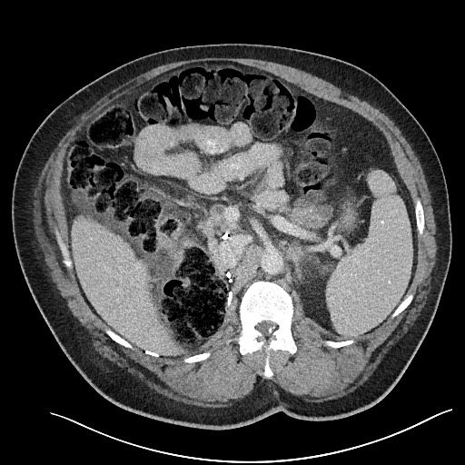 File:Closed loop obstruction - internal hernia into nephrectomy bed (Radiopaedia 59867-67320 A 47).jpg