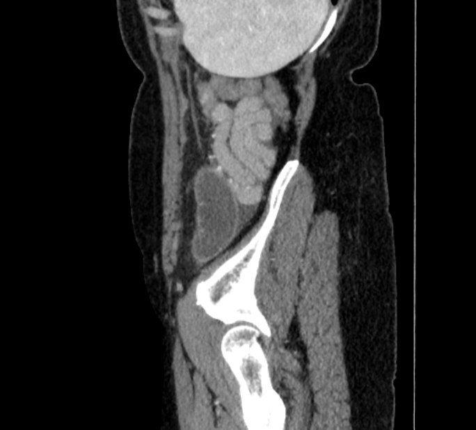 Closed loop small bowel obstruction (Radiopaedia 71211-81508 C 149).jpg