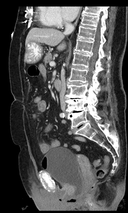 Closed loop small bowel obstruction - adhesions (Radiopaedia 59269-66611 C 58).jpg