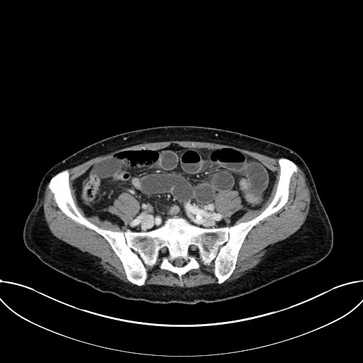 File:Closed loop small bowel obstruction - adhesive band with a C-shaped loop (Radiopaedia 83832-99018 Axial 34).jpg