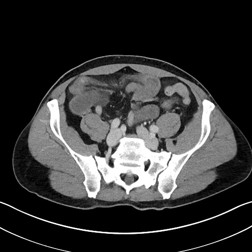 Closed loop small bowel obstruction - internal hernia (Radiopaedia 57806-64778 B 91).jpg