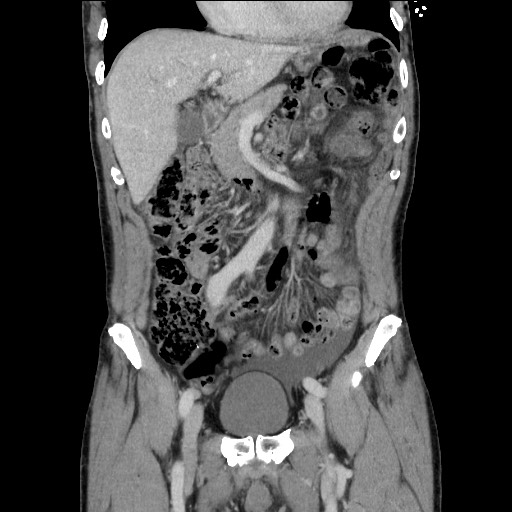 Closed loop small bowel obstruction - omental adhesion causing "internal hernia" (Radiopaedia 85129-100682 B 51).jpg