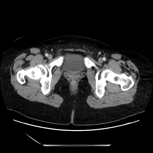 Closed loop small bowel obstruction due to adhesive bands - early and late images (Radiopaedia 83830-99014 A 155).jpg