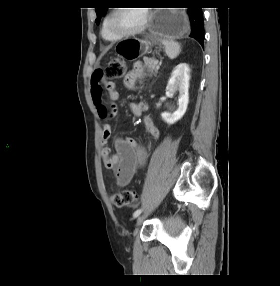 Closed loop small bowel obstruction with ischemia (Radiopaedia 84180-99456 C 64).jpg