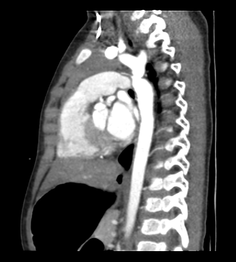 Coarctation of aorta (Radiopaedia 27427-27622 Sagittal C+ CTPA 75).png
