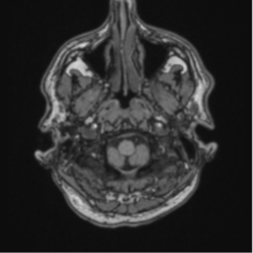 File:Colloid cyst of the third ventricle (Radiopaedia 86571-102662 Axial T1 11).png