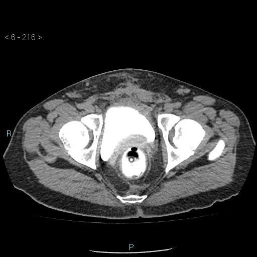 Colo-cutaneous fistula (Radiopaedia 40531-43129 A 90).jpg