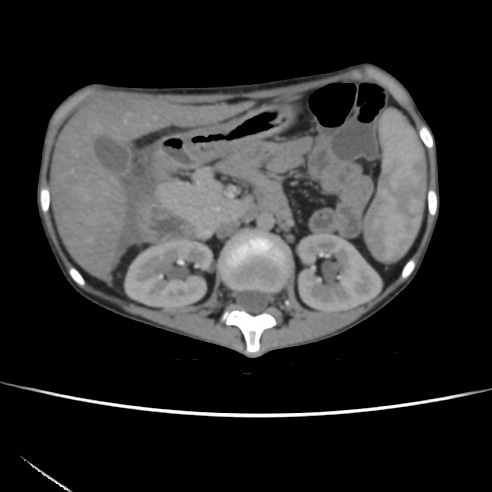 File:Colocolic fistula - Crohn disease (Radiopaedia 57063-63955 A 27).jpg