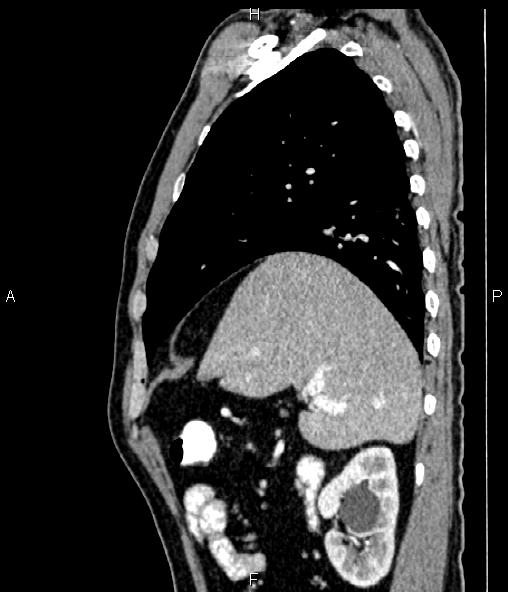 Colon adenocarcinoma (Radiopaedia 83266-97671 D 36).jpg