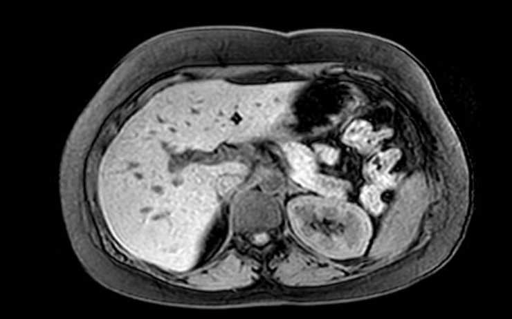 Colon adenocarcinoma with Krukenberg tumors, advanced pregnancy (Radiopaedia 67279-76645 A 62).jpg
