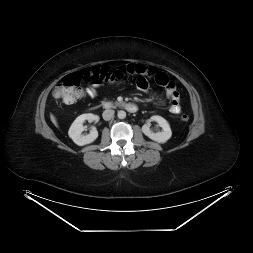 File:Colonic intussusception due to adenocarcinoma (Radiopaedia 86828-102987 Axial 35).jpg