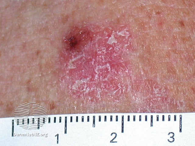 File:Intraepidermal carcinoma (DermNet NZ lesions-scc-in-situ-2918).jpg