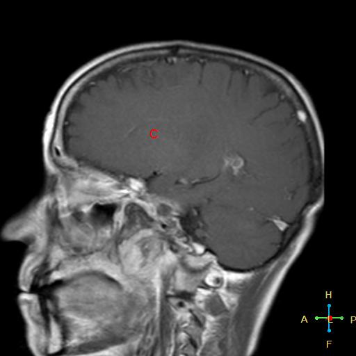 File:Nasopharyngeal carcinoma infiltrating the clivus (Radiopaedia 25229-25481 Sagittal T1 C+ 6).jpg
