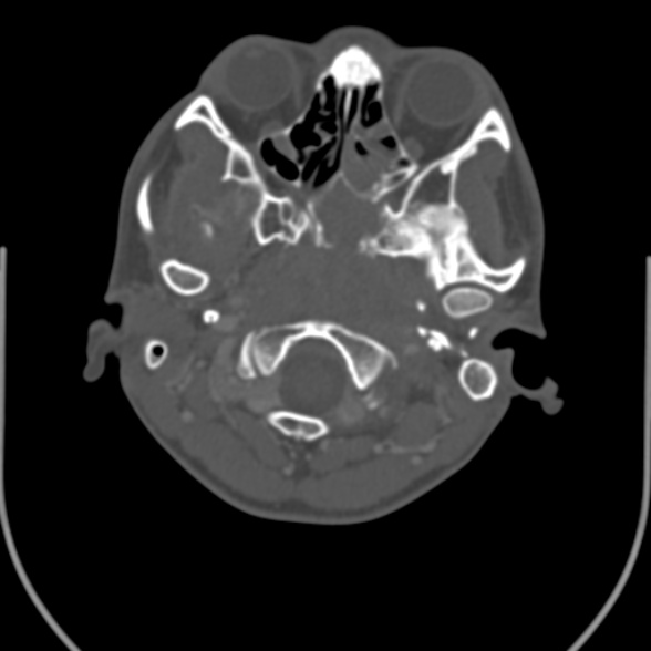 Nasopharyngeal carcinoma with skull base invasion (Radiopaedia 53415-59705 Axial bone window 31).jpg