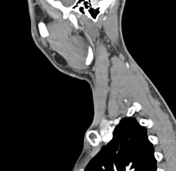 File:Nasopharyngeal carcinoma with skull base invasion (Radiopaedia 53415-59705 C 11).jpg