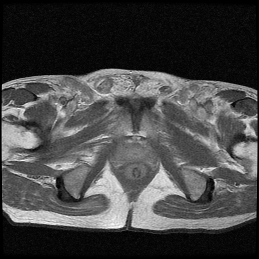 File:Necrotizing epididymo-orchitis with intra-testicular abscess (Radiopaedia 29397-29860 Axial T1 C+ 6).jpg