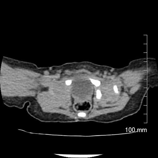 File:Neonatal neuroblastoma (Radiopaedia 56651-63438 Axial non-contrast 76).jpg