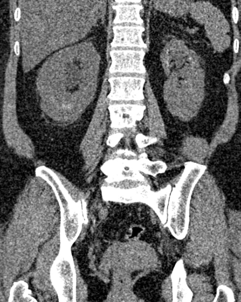 File:Nephrostomy for urosepsis (Radiopaedia 26180-26330 non-contrast 60).jpg