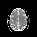 File:Neuro-Behcet's disease (Radiopaedia 21557-21505 Axial ADC 16).jpg