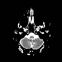 File:Neuro-Behcet's disease (Radiopaedia 21557-21505 Axial ADC 4).jpg