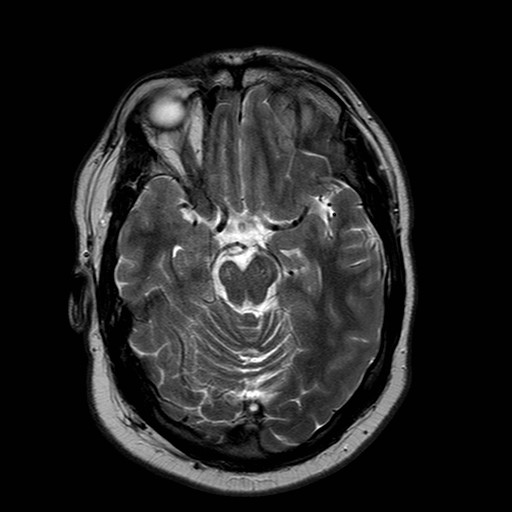 File:Neuro-Behcet's disease (Radiopaedia 21557-21506 Axial T2 11).jpg