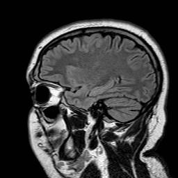 File:Neuro-Behcet's disease (Radiopaedia 21557-21506 Sagittal FLAIR 9).jpg