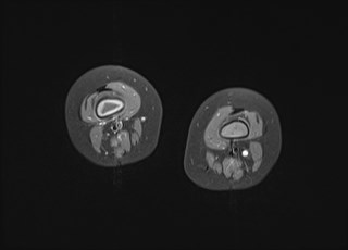 File:Neuroblastoma with bone metastases (Radiopaedia 67080-76414 Axial T1 C+ fat sat 15).jpg