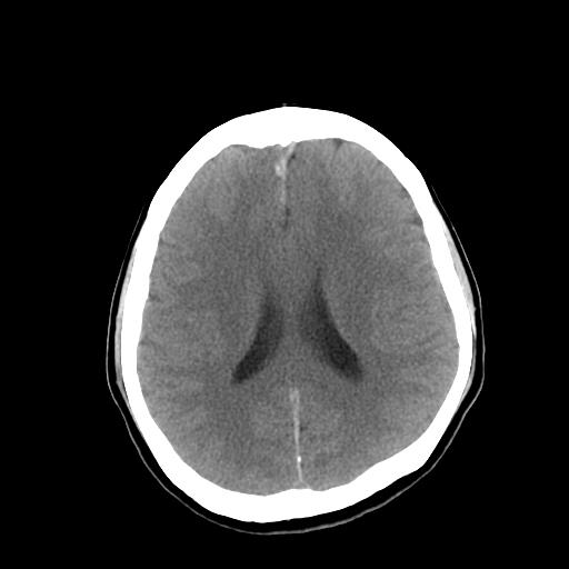 File:Neurofibromatosis type 2 (Radiopaedia 25389-25637 Axial non-contrast 16).jpg