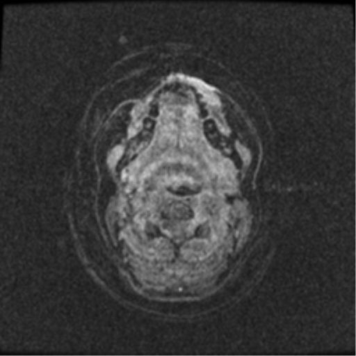 Neurofibromatosis type 2 (Radiopaedia 45229-49244 Axial T1 C+ 120).png
