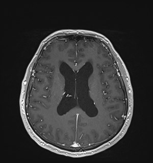 Neurofibromatosis type 2 (Radiopaedia 79097-92049 Axial T1 C+ 119).jpg