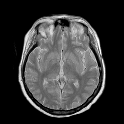 File:Neurofibromatosis type 2 (Radiopaedia 8713-9518 Axial Gradient Echo 13).jpg