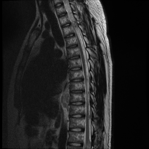 File:Neurofibromatosis type 2 (spinal manifestations) (Radiopaedia 53943-60070 C 8).png